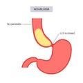 Esophageal achalasia disease