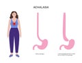 Esophageal achalasia disease