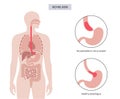 Esophageal achalasia disease