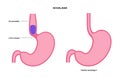 Esophageal achalasia disease