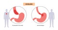 Esophageal achalasia disease