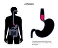 Esophageal achalasia disease