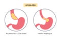 Esophageal achalasia disease