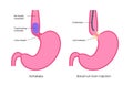 esophageal botulinum toxin injection