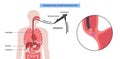 esophageal botulinum toxin injection