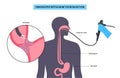 esophageal botulinum toxin injection