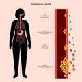 esophageal cancer stages