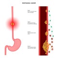 esophageal cancer stages Royalty Free Stock Photo