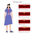 esophageal cancer stages