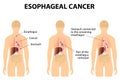 Esophageal Cancer