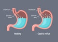 Esophageal gastric reflux acid indigestion. Gastrointestial stomach heartburn gerd gastric reflux