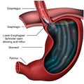 Esophageal sphincter anatomy Reflux 3d medical illustration