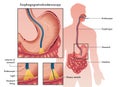 Esophagogastroduodenoscopy 