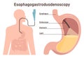 Esophagogastroduodenoscopy. Medical diagnostics of the esophageal, stomach Royalty Free Stock Photo