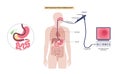 Esophagogastroduodenoscopy medical procedure