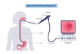 esophagogastroduodenoscopy medical procedure