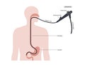 esophagogastroduodenoscopy medical procedure Royalty Free Stock Photo