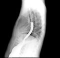 Esophagram or Barium swallow Lateral view .