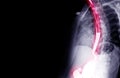 Esophagram or Barium swallow oblique view showing esophagus for diagnosis GERD