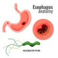 Esophagus anatomy and helicobacter pylori medical promo poster