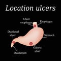 Esophagus ulcer affected. Ulcer of esophagus. Stomach ulcer affected. Gastric ulcer. Duodenum ulcer affected. Vector