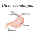 Esophagus ulcer affected. Ulcer of esophagus