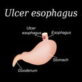 Esophagus ulcer affected. Ulcer of esophagus. Vector illustration on a black background