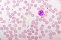 Essential thrombocytosis blood smear