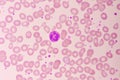 Essential thrombocytosis blood smear Royalty Free Stock Photo