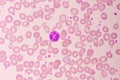 Essential thrombocytosis blood smear