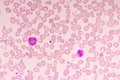 Essential thrombocytosis blood smear