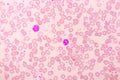 Essential thrombocytosis blood smear