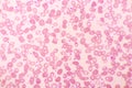 Essential thrombocytosis blood smear