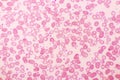 Essential thrombocytosis blood smear Royalty Free Stock Photo