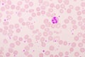 Essential thrombocytosis blood smear