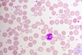 Essential thrombocytosis blood smear