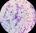 Essential thrombocytosis blood smear showing abnormal high volume of platelet and White Blood Cell analyze by microscope.