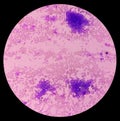 Essential thrombocytosis blood smear showing abnormal high volume of platelet and White Blood Cells. Panmyelosis.