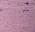 Essential thrombocytosis blood smear showing abnormal high volume of platelet and White Blood Cells. Panmyelosis.