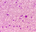 Essential thrombocytosis blood smear showing abnormal high volume of platelet and White Blood Cells. Myeloprokiferative disorder.