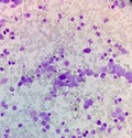 Hematological slide under microscopy showing Essential thrombocytosis, abnormal high volume of platelet and White Blood Cell