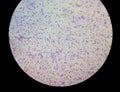 Essential thrombocytosis, abnormal high volume of platelet and White Blood Cell analyze by microscope