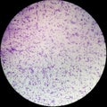 Essential thrombocytosis blood smear showing abnormal high volume of platelet and White Blood Cell analyze by microscope.