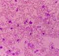 Essential thrombocytosis blood smear showing abnormal high volume of platelet and White Blood Cells. Panmyelosis.