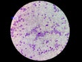 Essential thrombocytosis under microscopy, abnormal high volume of platelet and WBC