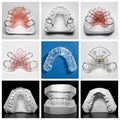 Essix retainer surrounded by orthodontic appliances and study models