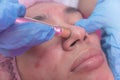 An Esthetician performs a Diamond peel facial, a type of microdermabrasion procedure. Exfoliating the skin of the face. At a