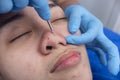 An esthetician uses a comedone extractor to dislodge blackheads from a patient\'s nose. Facial procedure and treatment Royalty Free Stock Photo