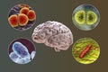 Etiology of bacterial meningitis Royalty Free Stock Photo