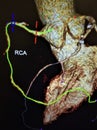 Angiography atherosclerotic changes vessels heart